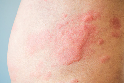 one type of fibromyalgia rash